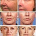 Mask Reduce Fine Lines